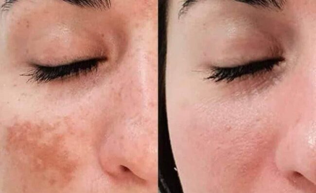 Glutatión Quitar Manchas de la Cara